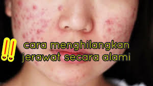 Ia hanya sebagai upaya mencegah jerawat dan. Cara Menghilangkan Jerawat Secara Alami Murah Meriah Youtube