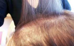 However, in some cases, the number of hair strands lost a single day far exceeds the number of hairs reproduced on the scalp Common Causes Of Hair Loss In Your 20 S And 30 S Hairatin