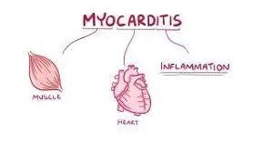 Image result for Myocarditis