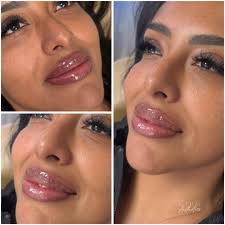 Mini hydration & plump with Kysse😘 👩‍⚕️Savannah Klein, MSN, NP-BC  💉Director of Aesthetics & Wellness ✨Arizona Health & Wellness Clinic  📍Gilbert, AZ 📞 480-931-3053 ⚠️ Consult with provider to determine the best