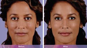 skin dermal fillers university of utah health