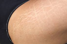 Wiegt sheabutter, mandelöl, kokosöl und jojobaöl ab und gebt sie in ein sauberes, leeres. Hausmittel Gegen Dehnungsstreifen Heilpraxis