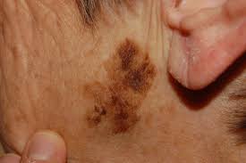 Even if one cancer cell is left behind, it can grow and divide to become a new tumour. The Abcde Rule Of Skin Cancer