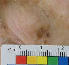 When cancerous tumors form on connective tissues, it is a sarcoma. A Close Look At Common Lid Lesions