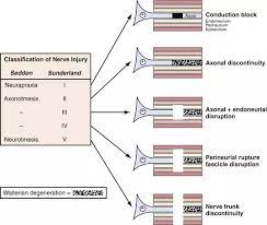 The lowest degree of nerve injury in which the nerve remains intact but signaling ability is damaged is called neurapraxia. What Does The Term Otmesis As In Neurotmesis And Axonotmesis Mean Quora