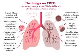 Copd Here S Exactly How It Affects Your Lungs Copd Copd Awareness Copd Symptoms