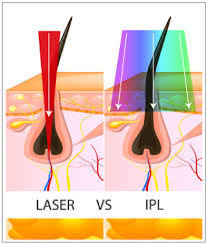 The main difference between ipl and laser hair removal devices is the light source used. Laser Hair Removal Acne Scar Treatment Laser Hair Removal Permanent Laser Hair Removal