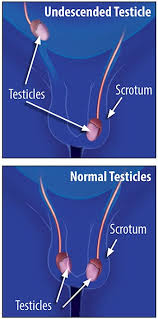Is it normal to have different size balls? Treatment Options For Children With Undescended Testicles Comparative Effectiveness Review Summary Guides For Consumers Ncbi Bookshelf