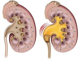 Image result for Nephrolithiasis