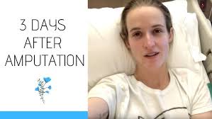 My leg is gone! Amputation update!
