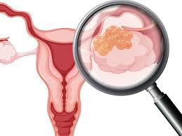 Ainul mustafa march 11, 2016. Gejala Awal Kanker Serviks Sesuai Stadium 1 4 Apa Saja