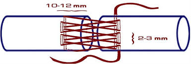 Appropriate suture techniques include the modified kessler stitch and the modified bunnell stitch (see the image below). Nesps Nesps 27th Annual Meeting Abstracts The Modified Silverskiold Tendon Repair Is Stronger Than The Mgh And Modified Kessler Repairs