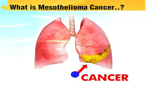 This disease primarily affects people above the age of 65 years old and is more. What Is Mesothelioma Hindi Poetry