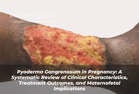 Image result for Pyoderma Gangrenosum