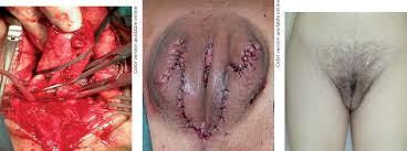 Male to female surgery pictures. Male To Female Transsexualism Technique Results And 3 Year Follow Up In 50 Patients Semantic Scholar