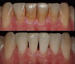They may also get a bachelor's degree. Dental Hygienist In Guildford Surrey Time To Go Fresher Brighter