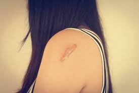 Hilangkan Keloid Dengan 6 Bahan Alami Ini Tanpa Operasi Dan Rasa Sakit Semua Halaman Nakita