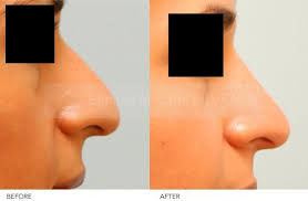 Page Not Found Rhinoplasty Nose Job Rhinoplasty Nose Jobs