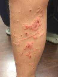Image result for contact dermatitis