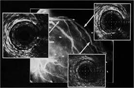 Transcatheter Closure With A “Single Lobe” Amplatzer Vascular Plug Of A  Tubular Patent Ductus Arteriosus In A Neonate With Transposition Of The  Great Arteries And Heart Failure | Cardiology In The Young |