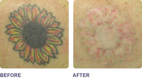 Tattoo Removal By Treatment Type Medspa