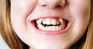 Furthermore, this issue can impair the functioning of your jar or bite. 7 Signs Your Child Needs Braces Sooner Rather Than Later