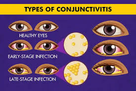 Image result for Conjunctivitis