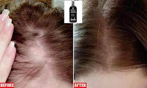 Hair loss due to genetics is not usually reversible, but shampoo and other products can help keep your hair in the best condition possible. Trichologist Shares 14 Shampoo Used To Treat Hair Loss Caused By Covid 19 Stress Daily Mail Online