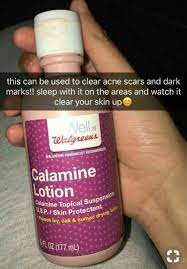 Tip — when applying calamine lotion, be. Pin On Remove Acne Scars