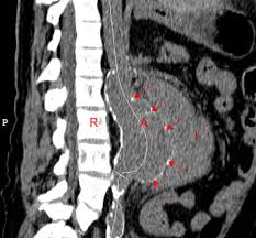 Critères sémiologiques de rupture d'anévrisme de l'aorte abdominale. Rupture Anevrisme Aorte Abdominale