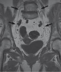Image result for Obturator Nerve Compression