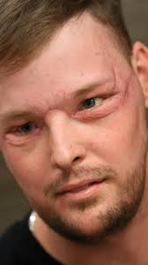 Twin tragedies give survivor a new face