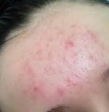 Klinisch manifestiert sich eine acne aestuvalis recht gleichförmig. Hilfe Ist Das Akne Pickel