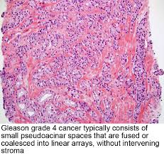 Pathology Outlines Grading Gleason