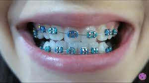 Pin By Carmen Soo On Braces Dental Braces Braces Teeth Colors Getting Braces
