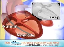 It also contains a computer that tracks your heart rate and rhythm. Icd Placement Youtube