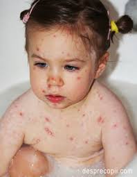 Varicela Varsatul De Vant La Copil Simptome Complicatii Tratament Desprecopii Com