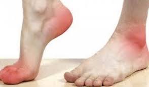 Ygeias Dromoi Oyriko O3y Ta Symptwmata Poy Xtypoyn Kokkino Remedies For Plantar Fasciitis Plantar Fasciitis Home Remedies