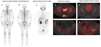 Bone scan for prostate cancer. Does Bone Scintigraphy Still Have A Role In The Era Of 68 Ga Psma Pet Ct In Prostate Cancer Springerlink