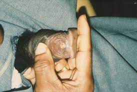 Syphilis is a sexually transmitted infection that can cause serious health problems if it is not treated. Syphilis Primary Syphilis Latent Syphilis Cardiovascular Syphilis Secondary Syphilis Tertiary Syphilis Neurosyphilis Dermatology Advisor