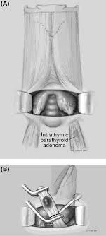 It just allows you to change the asset id for your custom sharingan, but without going to the stone. Ahns Series Do You Know Your Guidelines Optimizing Outcomes In Reoperative Parathyroid Surgery Definitive Multidisciplinary Joint Consensus Guidelines Of The American Head And Neck Society And The British Association Of Endocrine And