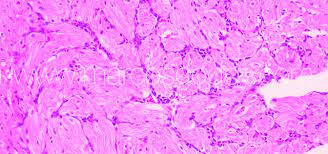 Entry of virus into myocytes, mediated through specific receptors such as the transmembrane coxsackievirus and adenovirus receptors (car) subacute: Miocarditis Asociada A Infeccion Sistemica Por Flavobacterium Psychrophilum En Trucha Arcoiris Oncorhynchus Mykiss Iv Histopatologia