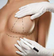 Breast Lift (Mastopexy) - Clinique Dallas