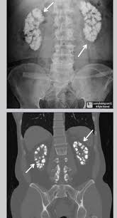 Medullary Nephrocalcinosis Upper Photo Of Conventional Radiograph Of Abdomen And Lower Photo Of Coro Radiology Radiology Imaging Diagnostic Medical Sonography