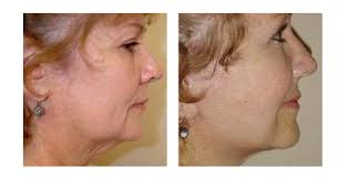 Facelift in Jacksonville. You deserve to Look Your Best!
