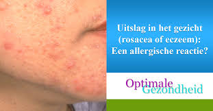 Ik geef je enkele tips voor een elastische, gehydrateerde en gezonde huid. Uitslag In Het Gezicht Rosacea Of Eczeem Een Allergische Reactie Optimalegezondheid Com