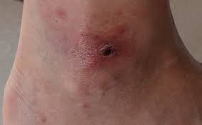 Image result for infected tick bite
