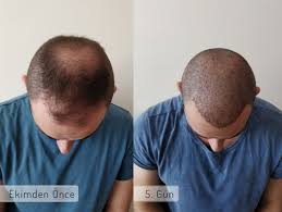 Estemylife 4000 Greft Prp Hiperbarik Oksijen 30 06 2018