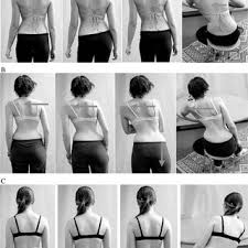There definitely are ways to fix scoliosis without surgery ! Pdf Physical Exercises In The Treatment Of Adolescent Idiopathic Scoliosis An Updated Systematic Review