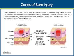 Image result for Burn Management